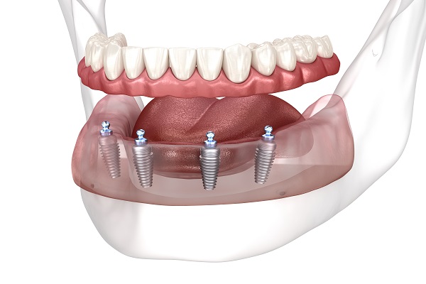 How Long Do All On   Implants Last?