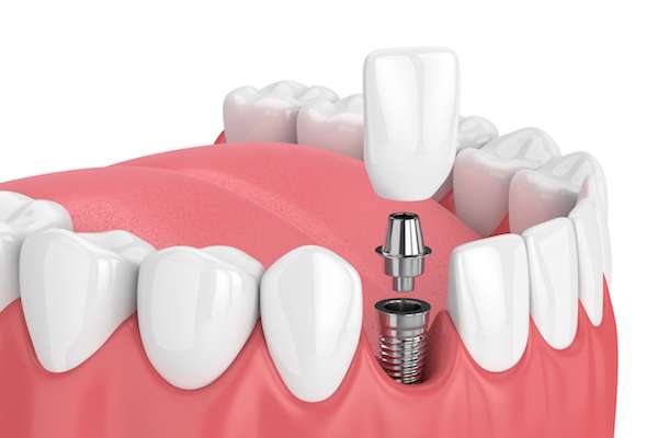 How Painful is Dental Implant Surgery from MM Family Dentistry in Austin, TX