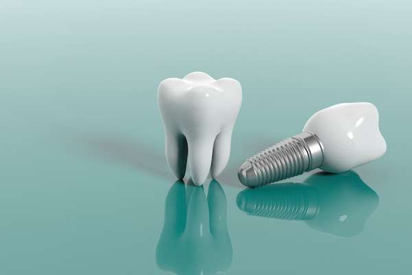 Multiple Teeth Replacement Options: One Implant for Two Teeth from MM Family Dentistry in Austin, TX